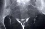 子宮卵管造影検査で卵管近位部の閉塞が見られる画像