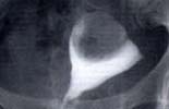 子宮卵管造影検査で卵管近位部の閉塞が見られる画像
